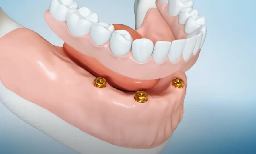 Protetyka na implantach